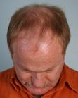Before Hair Transplant&nbsp;2 Sessions (Areas)